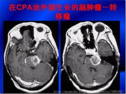 脑瘤的照片,揭示肿瘤形态与分布特征